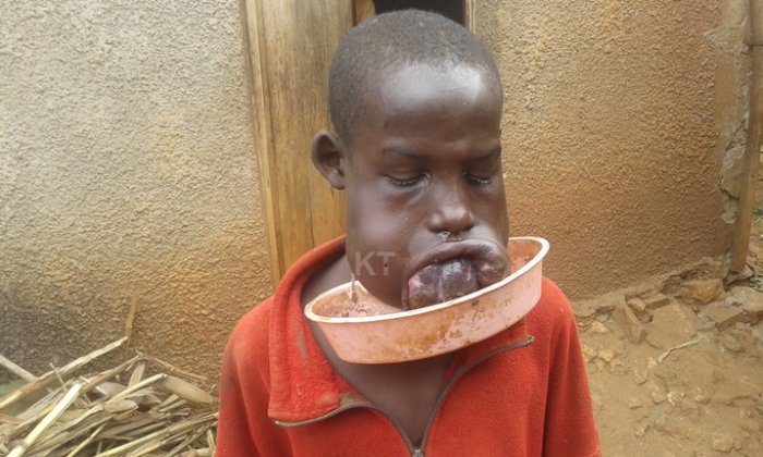 Leta y’u Rwanda yumvise ikibazo cy’umwana umaranye imyaka 16 uburwayi budasanzwe 