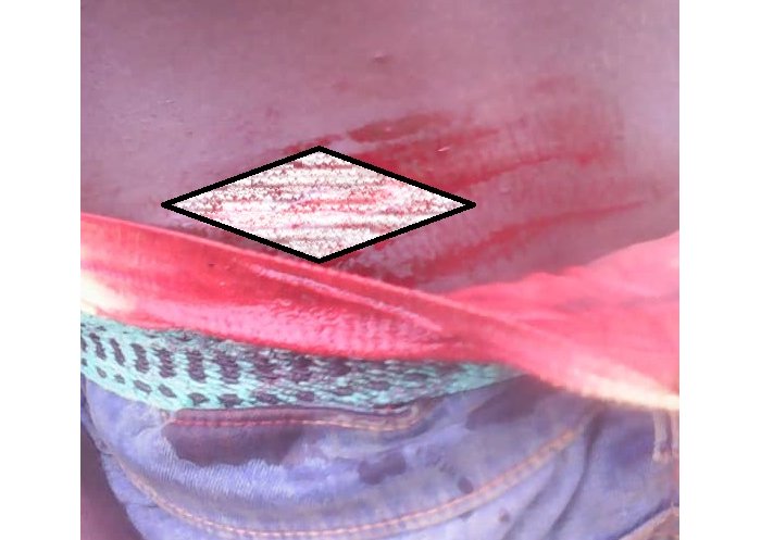 Huye&nbsp;: Umunyerondo arishinganisha nyuma yo gutemwa n’abenga inzoga z’inkorano bakanamubwira ko bazamwica