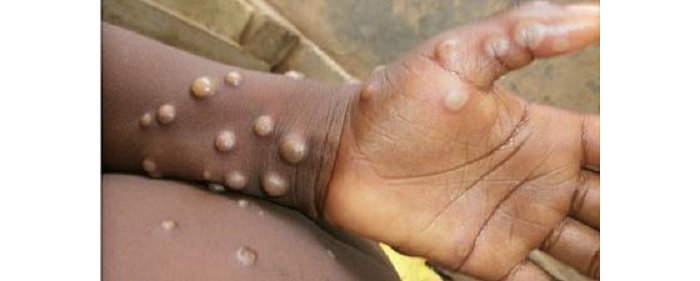 UMUBURO : Byemejwe ko  indwara iri guca ibintu ku Isi yandurira no mu mibonano mpuzabitsina 