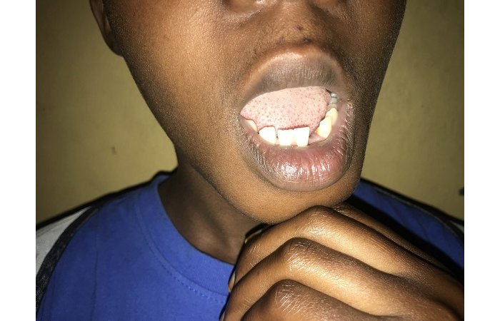 Rubavu : Amakuru Mashya ku  Mukobwa washinje Gitifu  w’Umurenge  kumukura iryinyo  amuziza kwanga ko baryamana