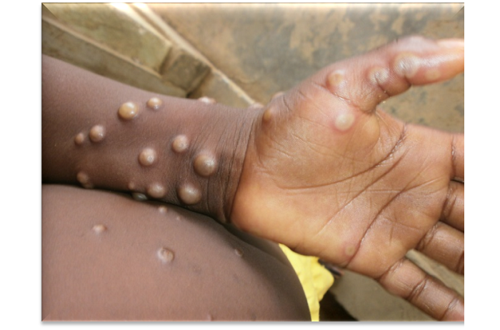 Indwara Abanyarwanda bise ’Ubushita bw’Inkende’ yageze mu baturanyi b’u Rwanda