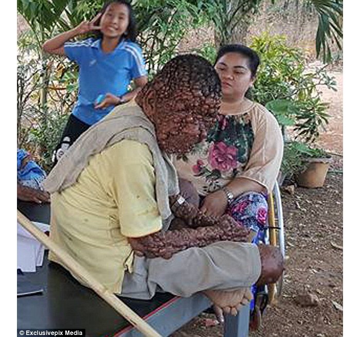 Uburwayi bw’ibibyimba bimwuzuye umubiri wose bituma atakibasha no kureba