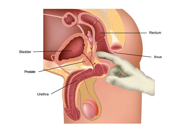 Sobanukirwa uburwayi bwa porositate bwibasira imyanya myibarukiro y’abagabo