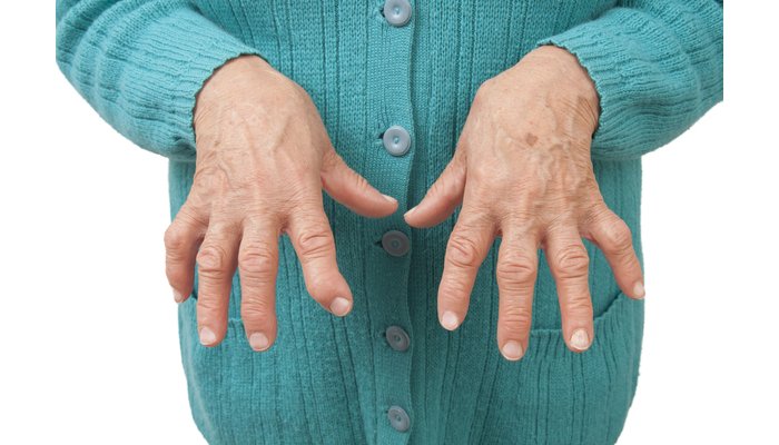 Sobanukirwa indwara ya Rubagimpande, ibimenyetso byayo n’uko wahangana nayo