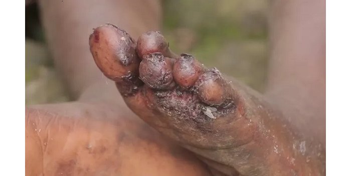  Musanze&nbsp;: Baratabariza  abaturanyi  babo  barembejwe n’amavunja 